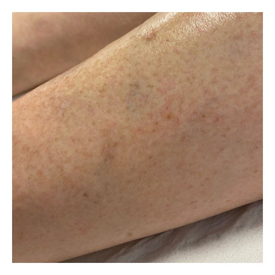 Isdin Ureadin Lotion10 Hidratação Intensa 100ml