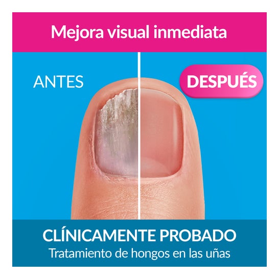 Excilor Forte Color Tratamento do Fungos das Unhas Nude 30ml