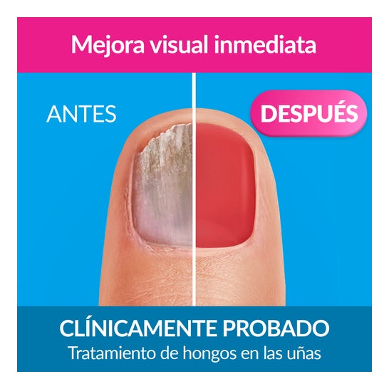 Excilor Forte Color Tratamento do Fungos das Unhas Red 30ml